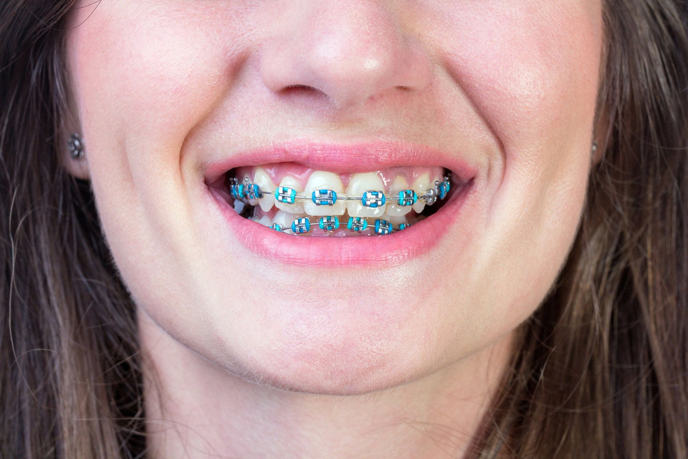 braces colors that make your teeth look white